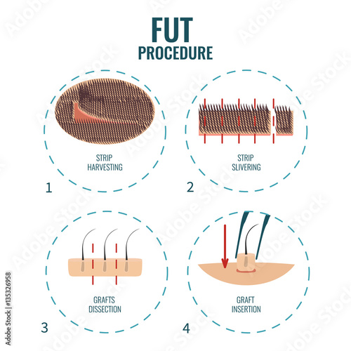 Follicular unit transplantation procedure stages. FUT hair loss treatment steps. Alopecia infographic medical design template. Clinics and diagnostic centers concept design. Vector illustration.