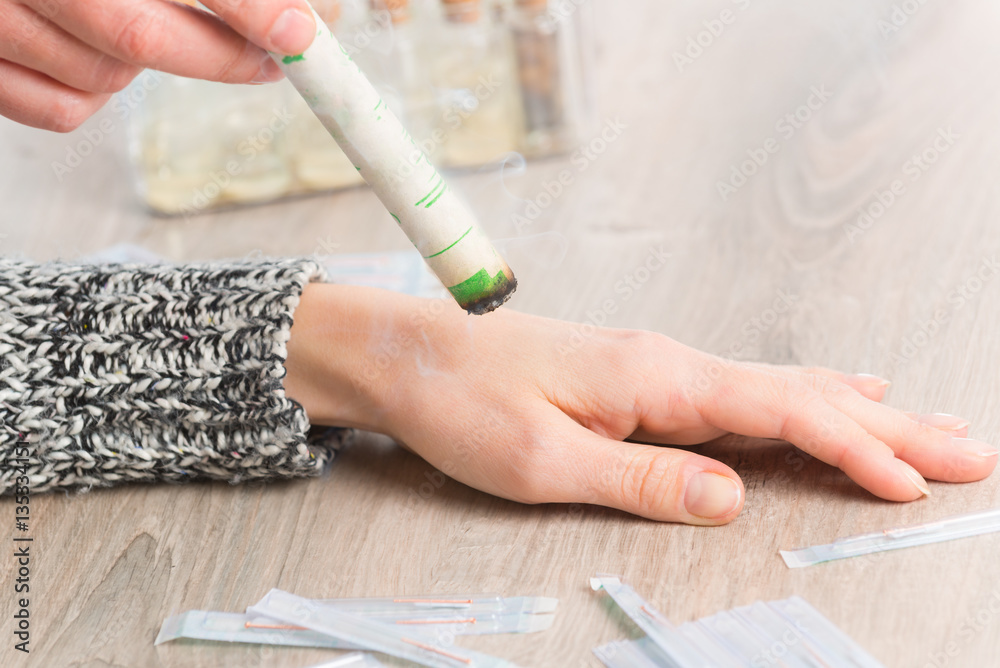 Obraz premium Therapist doing moxa treatment