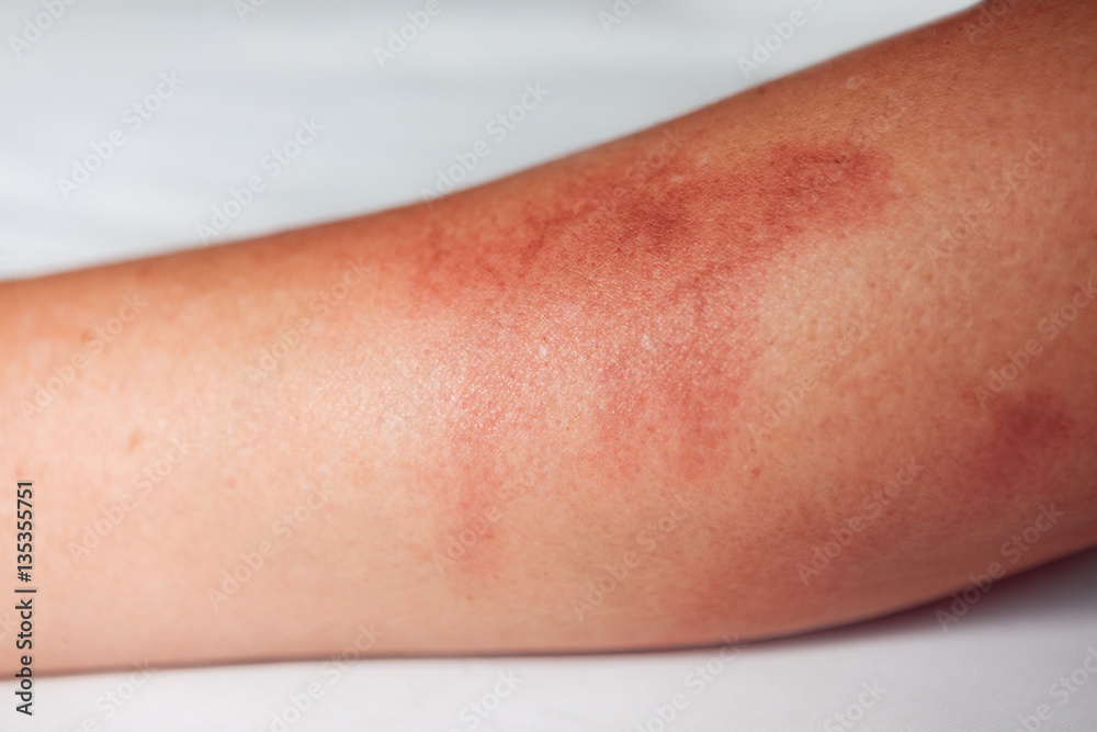 Naklejka premium Painful burns on female hand