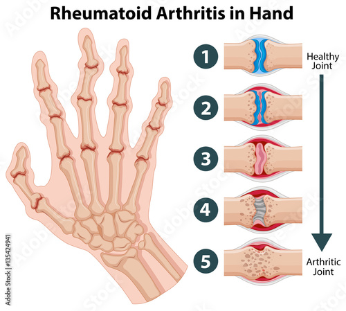 Diagram showing rheumatoid arthriitis in hand