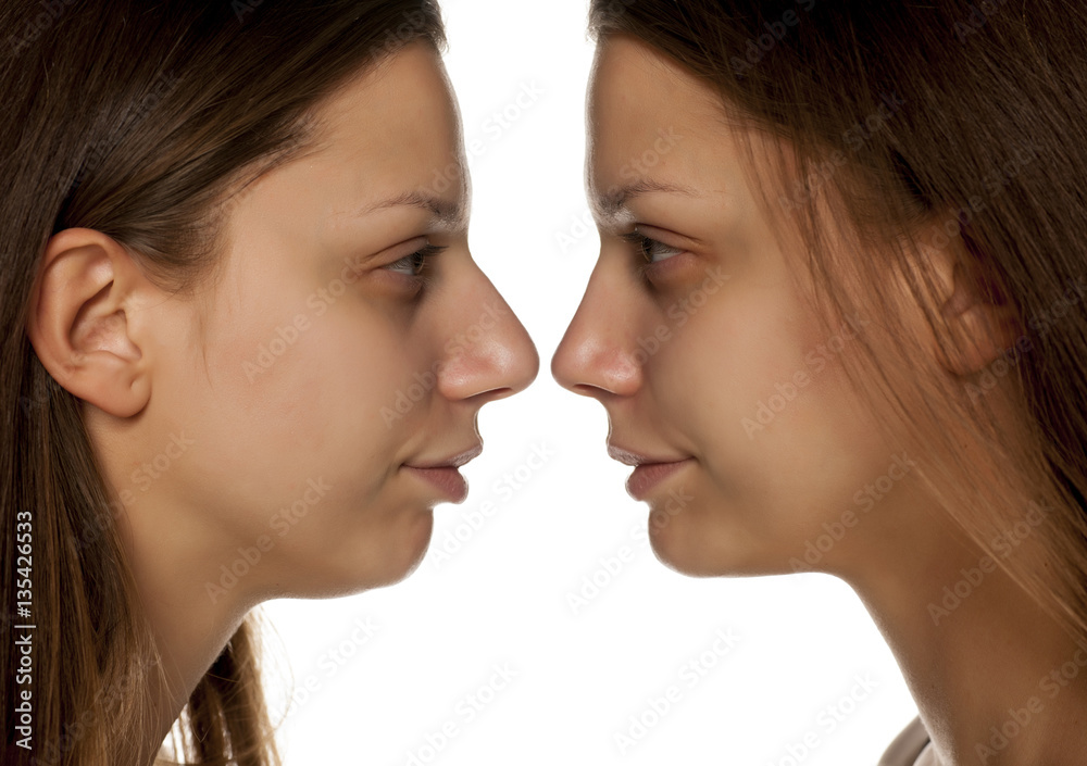 comarative portrait of young woman before and after nose correction on white background comarative portrait of young woman before and after nose correction on white background
