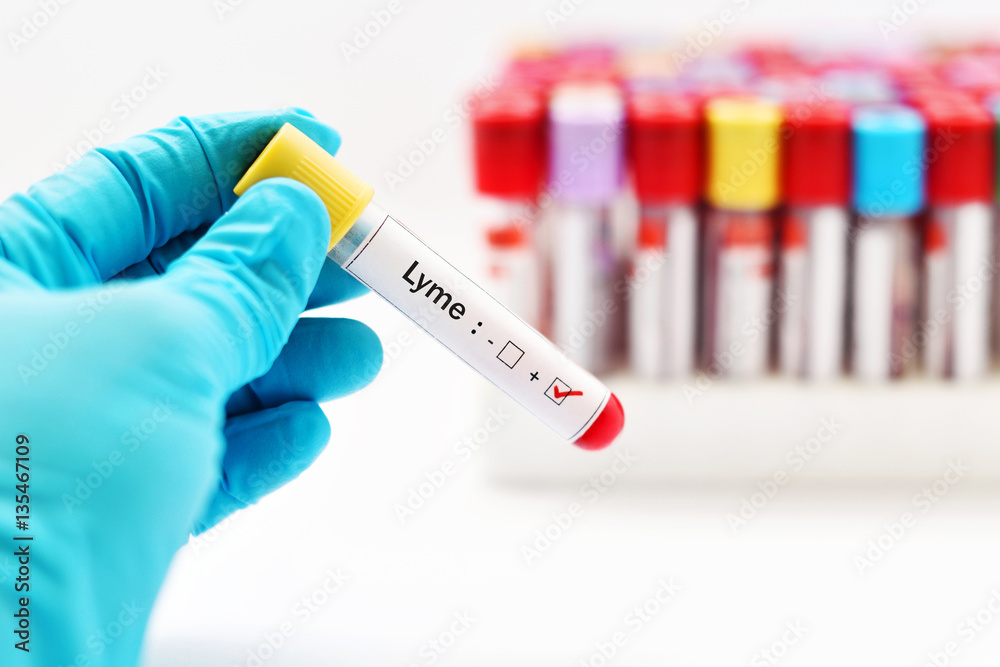 Fototapeta premium Blood sample positive with Lyme disease test