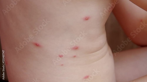 Chickenpox on the body of 5 year old girl
