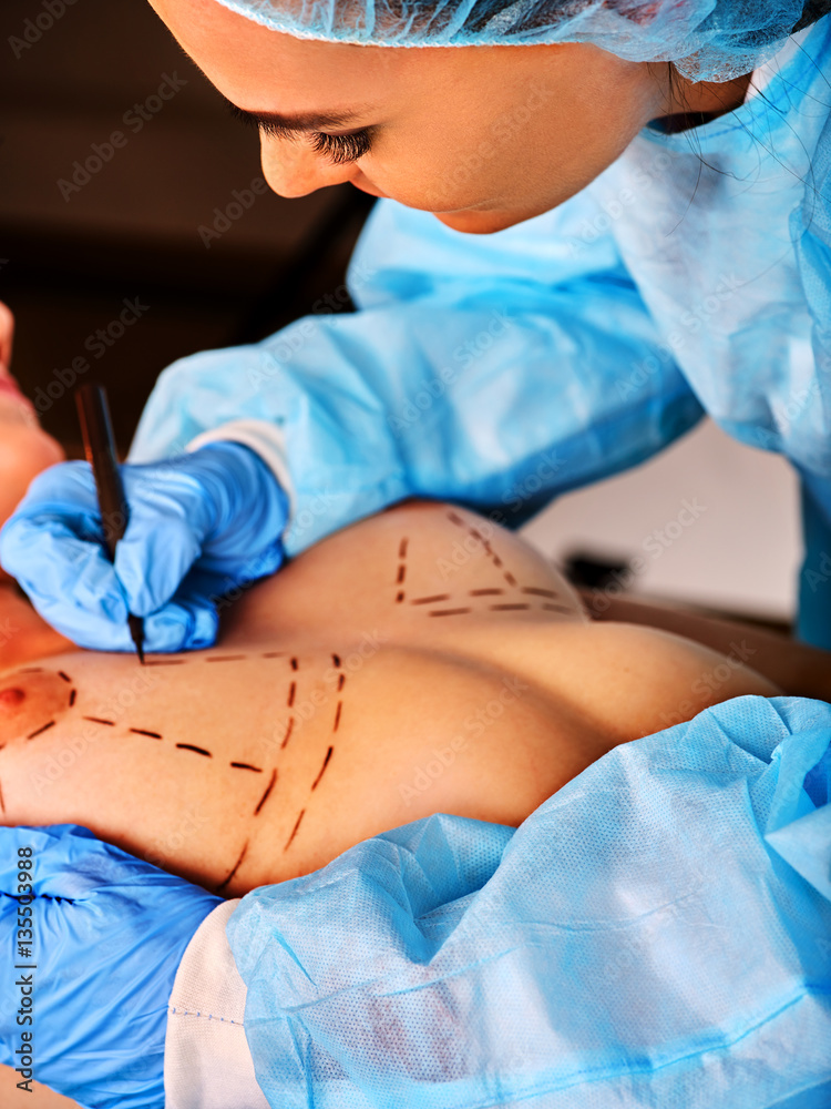 Fototapeta premium Breast surgery of body part. Implants for surgery augmentation. Doctor makes dotted line on female body on black background. Top view and close up of nipple. Female beautiful and healthy.