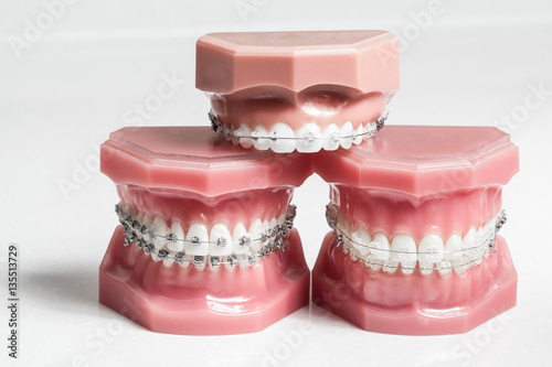 Three model jaws with wire braces stacked, example of dental and orthodontic technology for teeth alignment