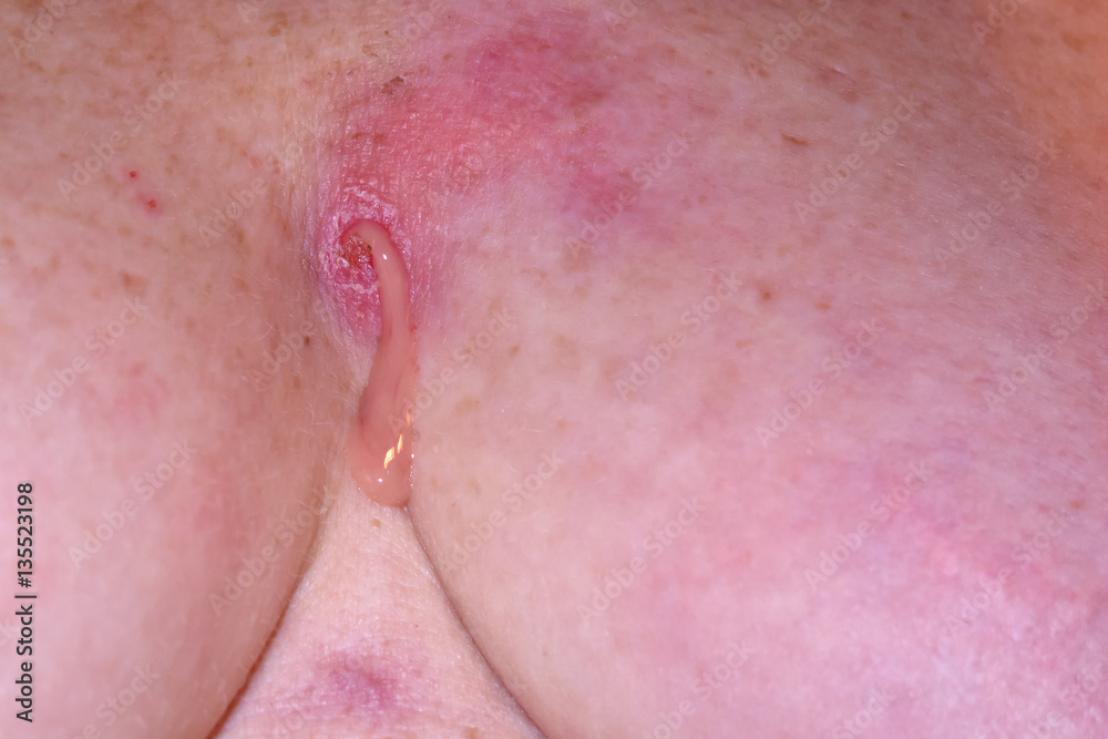 Fototapeta premium Leaking Staphylococcus Infection in between breasts of mature wo