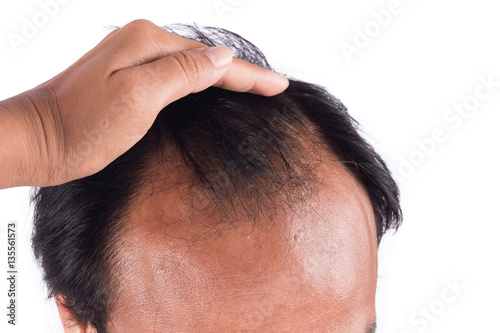 Bald head of young man o white background