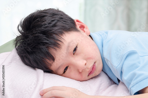 Young asian boy with rash on face lying on bed