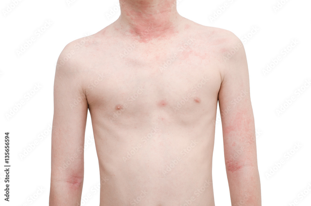Skin with rash Skin with rash