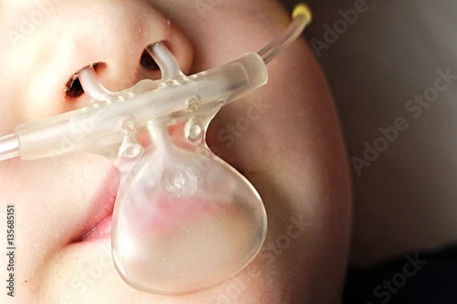 Capnography line for ETCO2 monitoring placed on mouth and nose of small girl