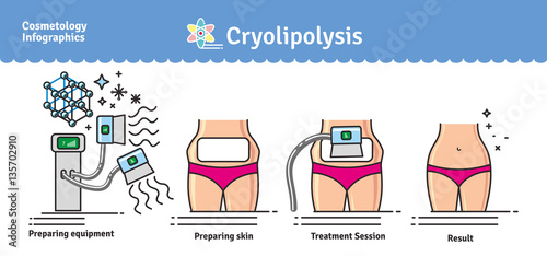 Vector Illustrated set with cosmetology Cryolipolysis treatment
