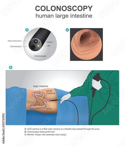 Colonoscopy is a test that allows your doctor to look at the inner lining of your large intestine. Human anatomy Illustration, Vector art.