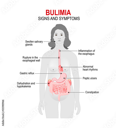Bulimia. Signs and symptoms