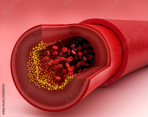 Fotografie Cholesterol plaque in blood vessel, 3D illustration