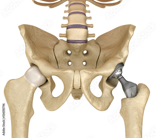 Hip replacement implant installed in the pelvis bone. Medically accurate 3D illustration photo