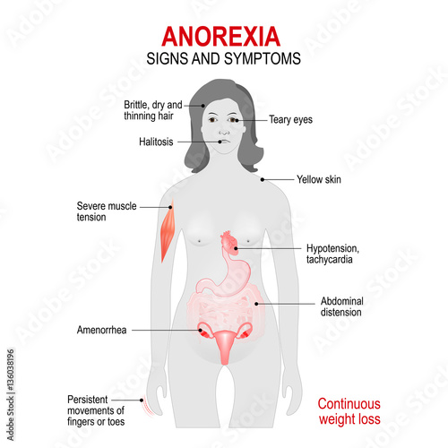 Anorexia nervosa. Signs and symptoms. photo