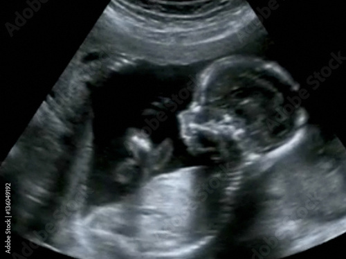 Valokuva Obstetric Ultrasonography Ultrasound Echography of a first month