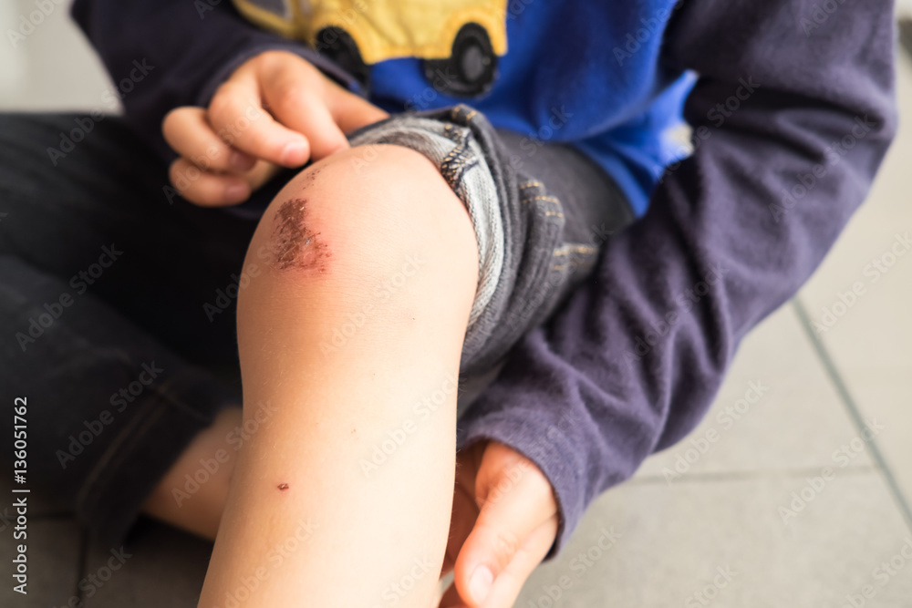 Wound on the knee of a small child Wound on the knee of a small child