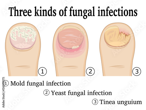 Three types of fungal infection on the toe