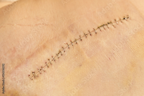Foto a wound on the skin