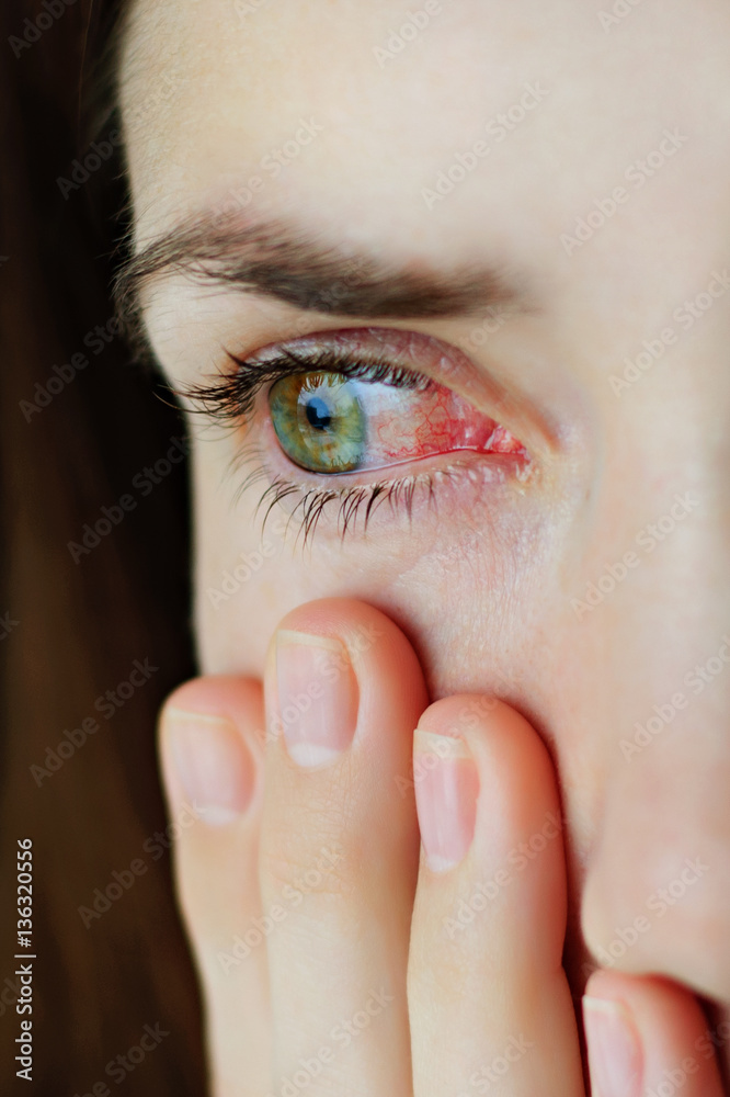 Fototapeta premium Closeup of irritated or infected red bloodshot eyes - conjunctivitis