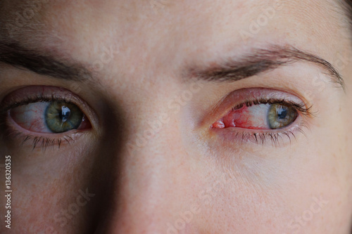 Closeup of irritated or infected red bloodshot eyes - conjunctivitis photo