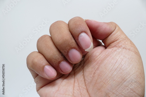 Close up of nail tear, feeling hurt finger