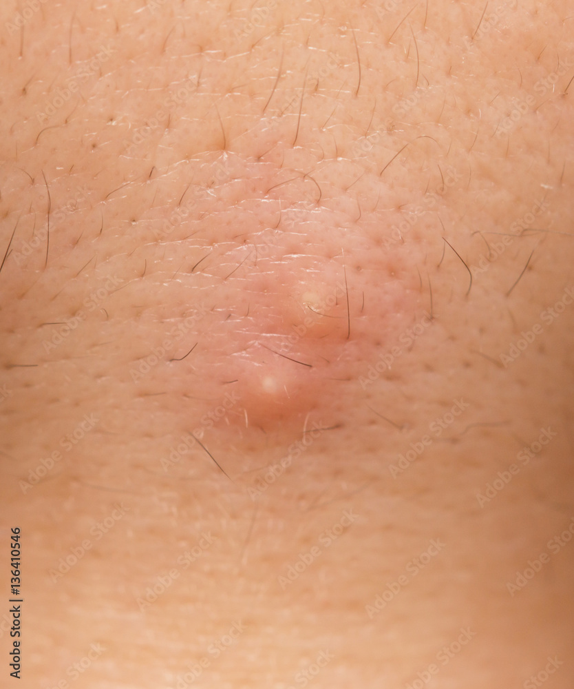 Fototapeta premium acne on the skin