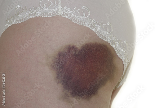 bruising on a skin - after trauma photo