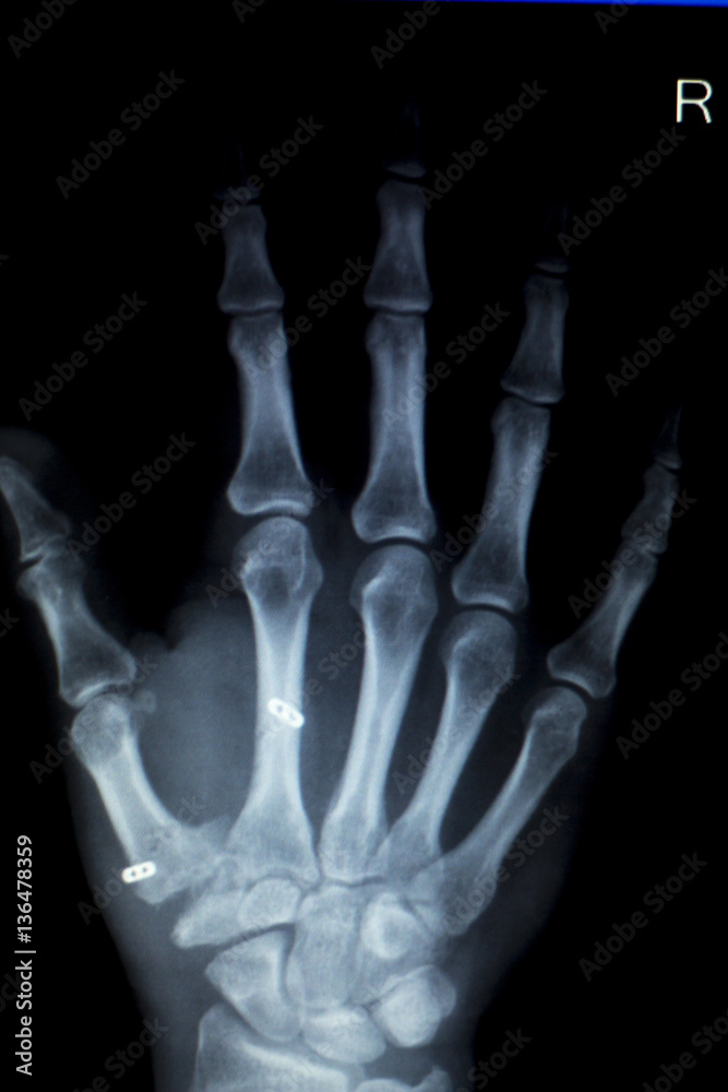 Hand fingers inury Xray scan Hand fingers inury Xray scan