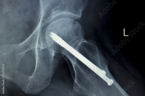Hip screw implant Xray scan