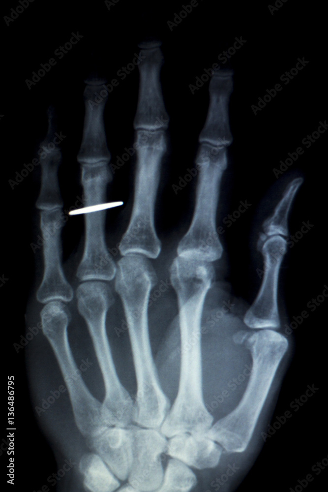 Hand fingers implant Xray scan Hand fingers implant Xray scan