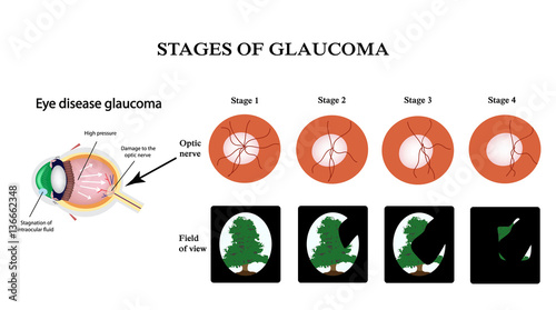 Glaucoma. The structure of the eye. The field of vision in glaucoma. Atrophy of the optic nerve. Infographics. Vector illustration on isolated background photo