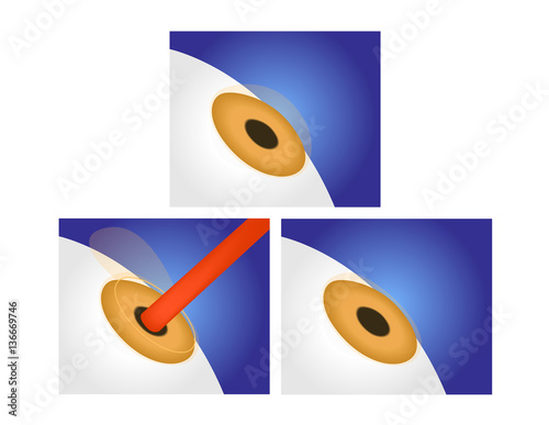 eye lasik icon , logo and vector