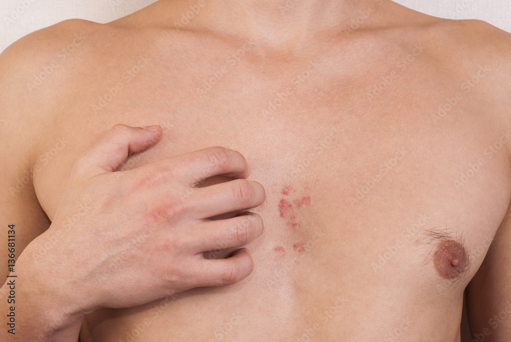 dermatitis on the chest of a man dermatitis on the chest of a man
