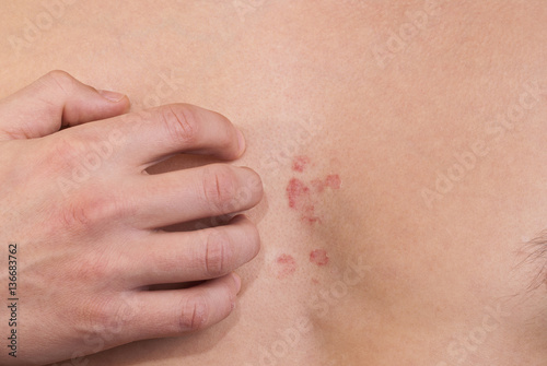 dermatitis on the chest of a man