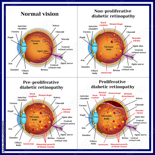 Types of diabetic retinopathy: non-proliferative, pre-proliferative diabetic retinopathy, proliferative retinopathy of retina. photo