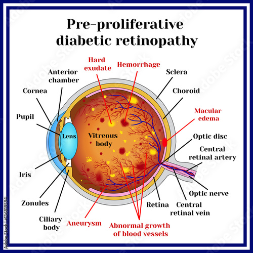 Types of diabetic retinopathy: pre-proliferative diabetic retinopathy.