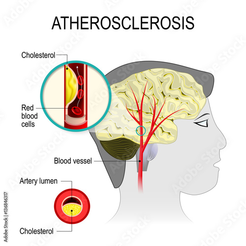 Cerebral artery with atherosclerosis
