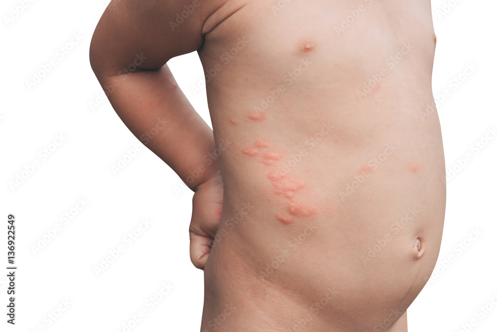 Boy with multiple and insect bites on body on white background Boy with multiple and insect bites on body on white background