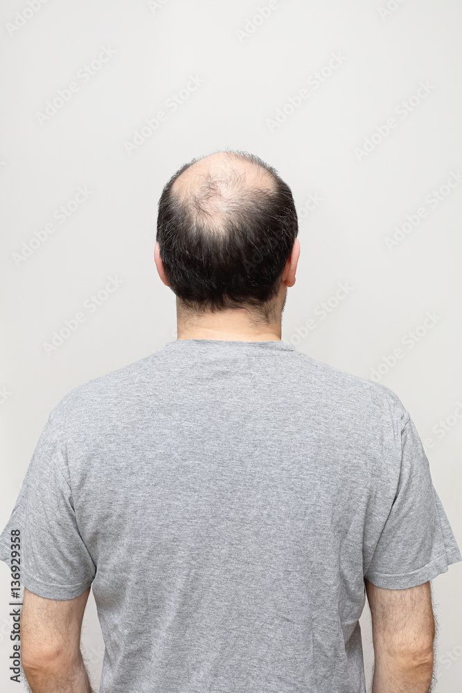 Bald Head Bald Head