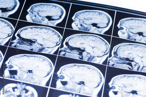 MRI of the brain. snapshot