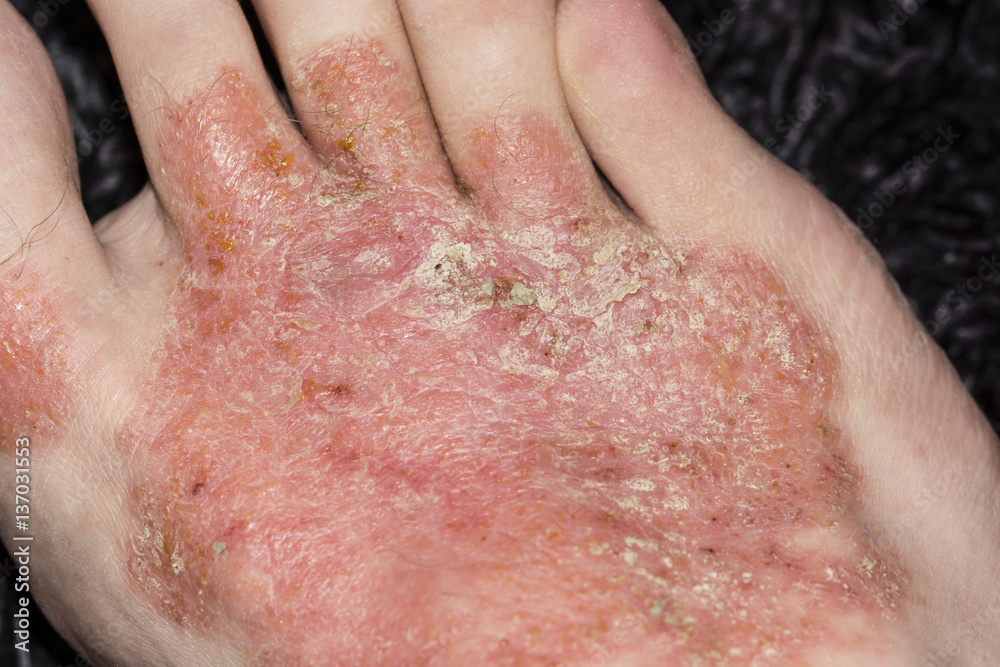 Fototapeta premium Disease of the skin on the foot - eczema.