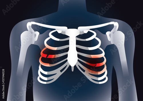 Red signal at the bones in rib cage break. Illustration about damage inside body.