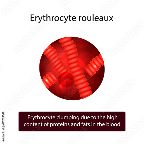 Rouleaux of red blood cells. Erythrocyte clumping due to the high content of proteins and fats in the blood. 