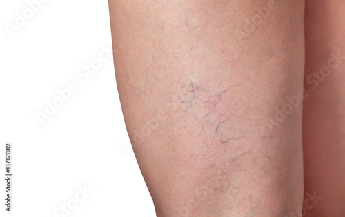 Varicose veins and capillary veins in the legs. Medical inspection and treatment of Telangiectasia.