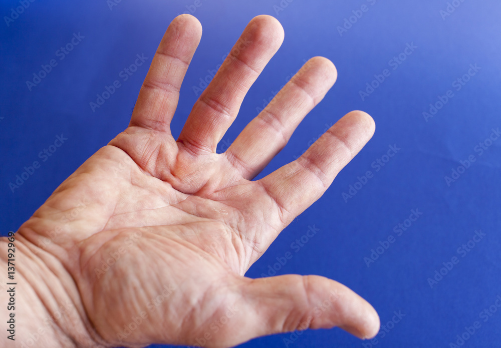 Hand of an man with Dupuytren contracture disease, against medical blue background Hand of an man with Dupuytren contracture disease, against medical blue background