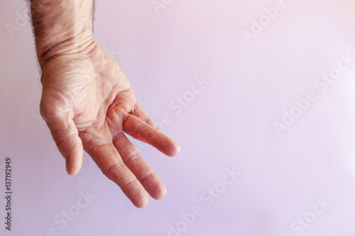 Hand of an man with Dupuytren contracture  disease, against  bright background  