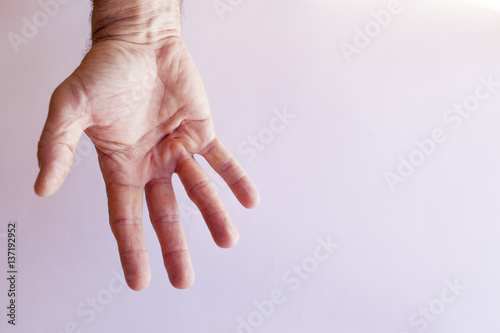 Hand of an man with Dupuytren contracture  disease, against  bright background  