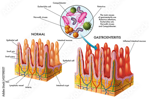 gastroenteritis photo
